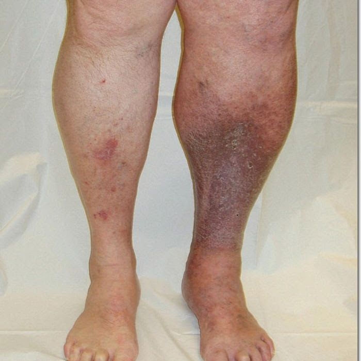 Health Matters, September 19 - Deep Vein Thrombosis (DVT) episode artwork