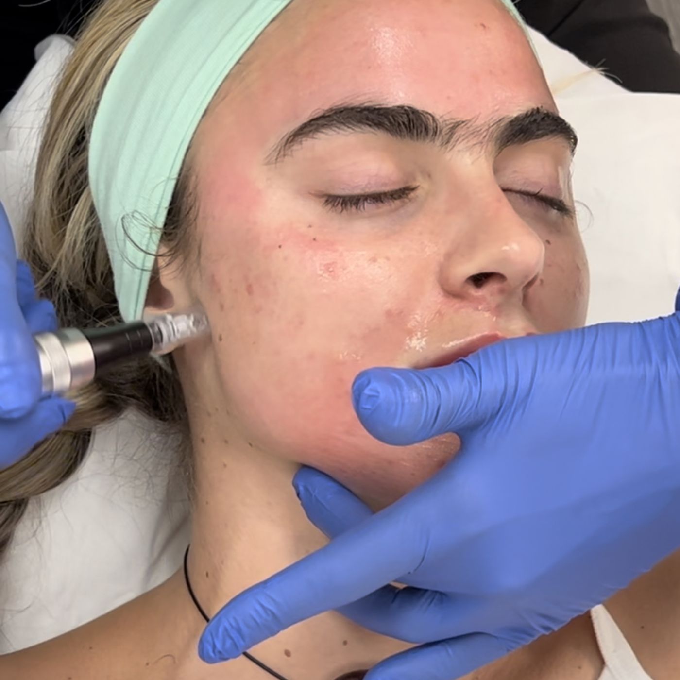 669: Advanced Microneedling Techniques for Skin Rejuvenation